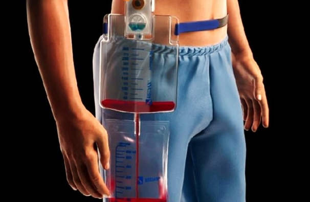 WearABLE: Un nou standard în mobilitate și siguranță pentru drenajul toracic