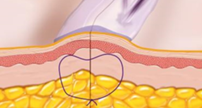 Dermabond strates
