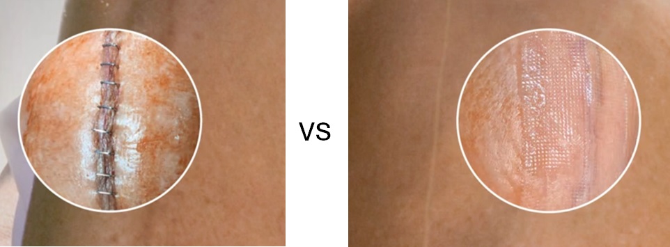 Dermabond vs scobe