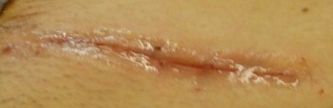 Dermabond wound